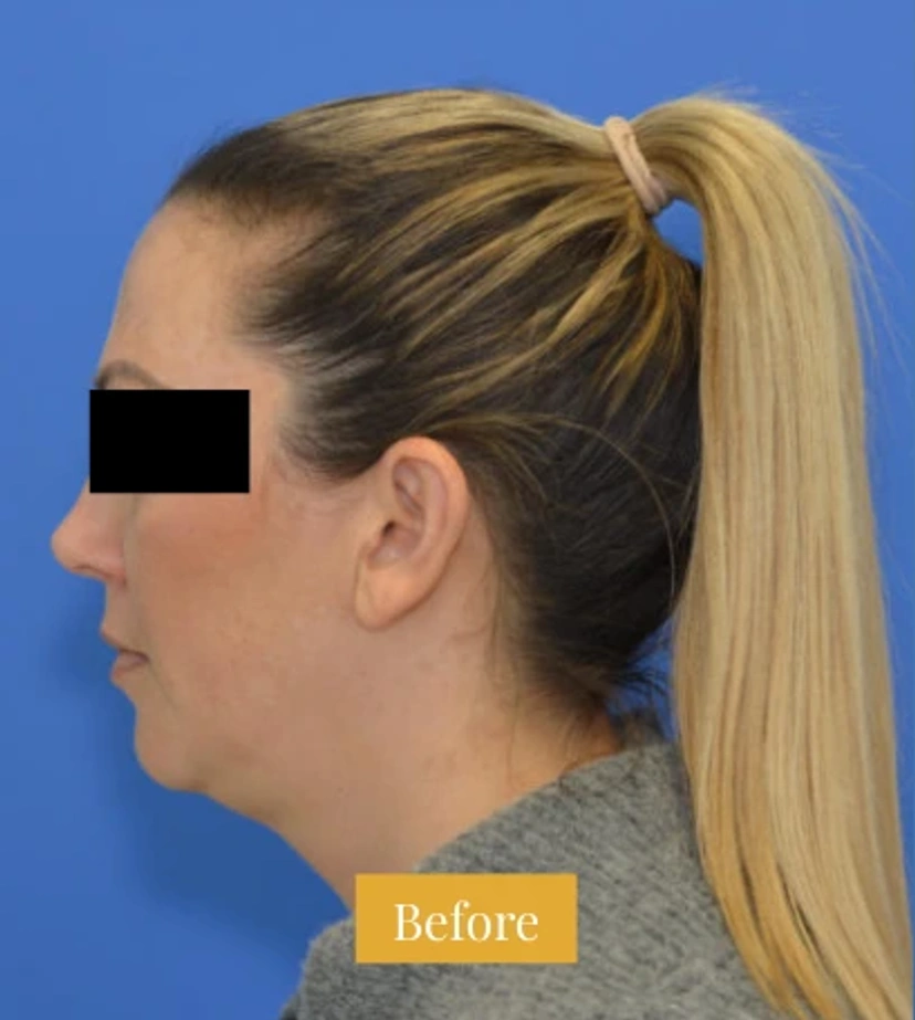 Mini Facelift/Short Scar - Patient 7 (before)