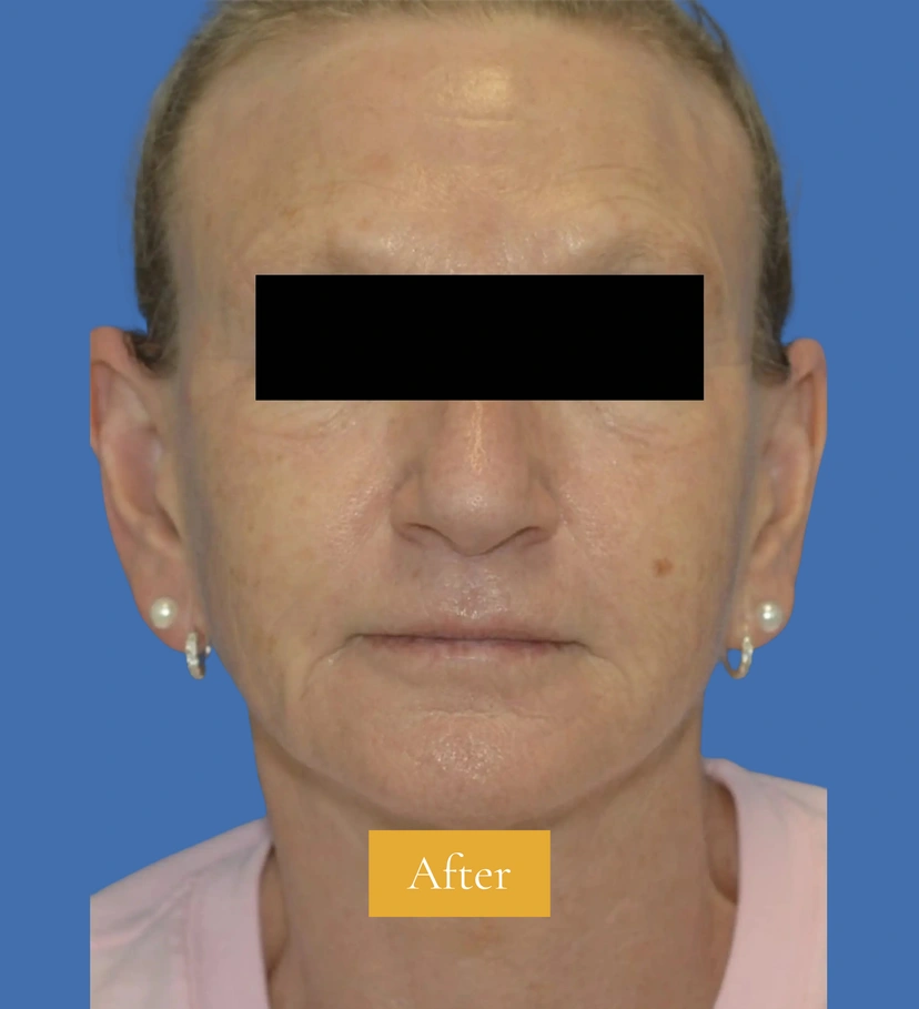 Dermal Fillers - Patient 4 (after)