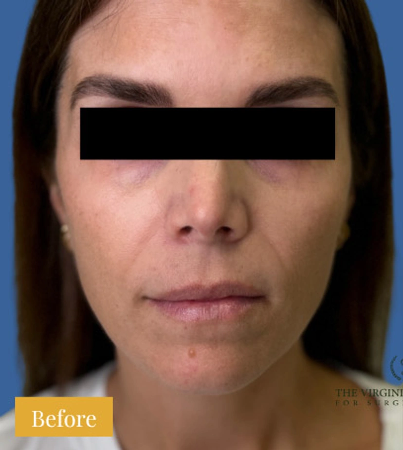 Sculptra - Patient 2 - Set 1 - Before