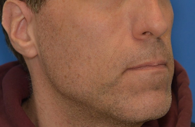 Sculptra - Patient 1 (before)