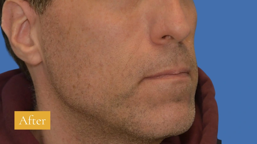 Sculptra - Patient 1 (before)