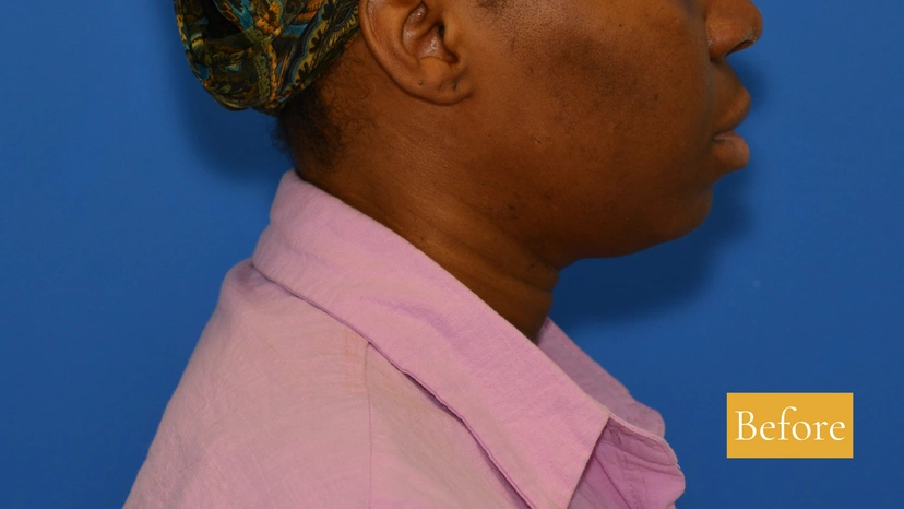 Chin Augmentation before side-left patient 1
