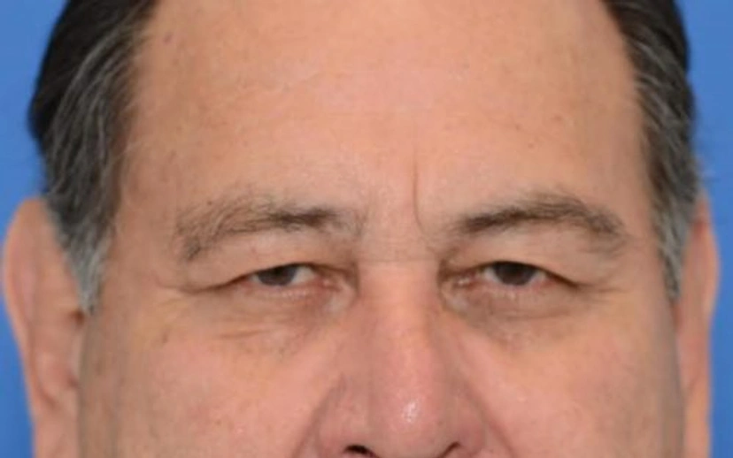 Upper Eyelid Surgery - Patient 1 (before)