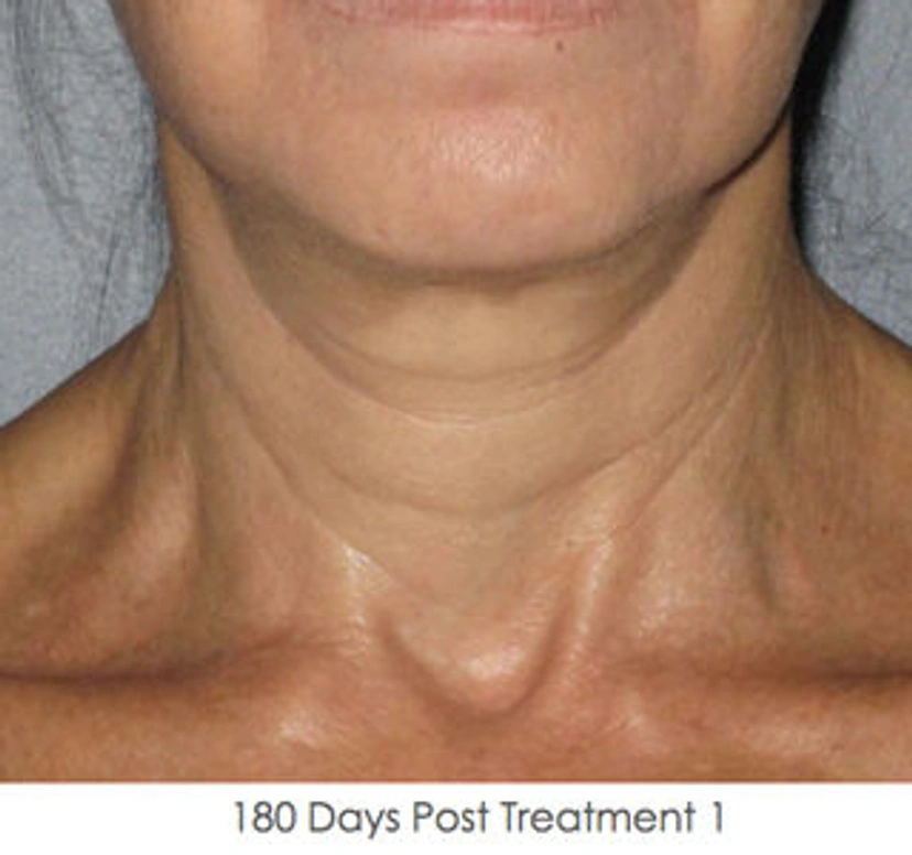 Asian eyelid surgery patient 3 result photo