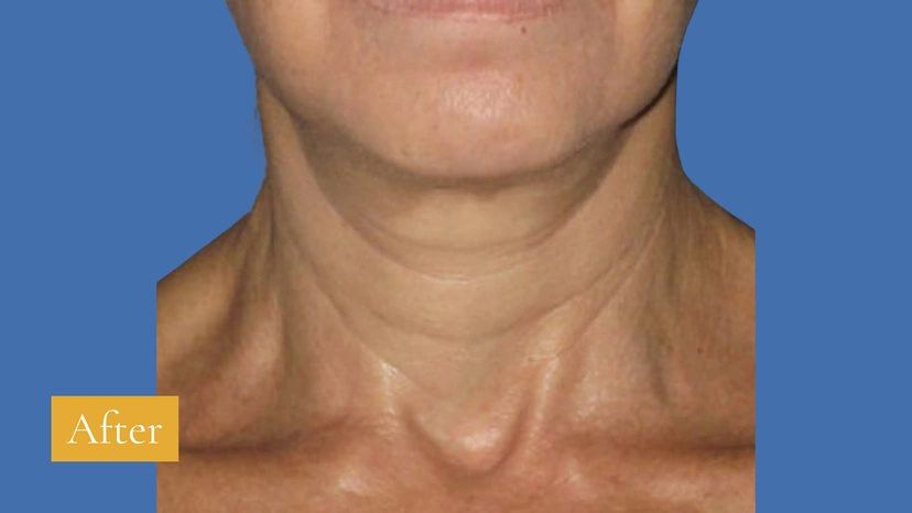 Asian eyelid surgery patient 3 result photo