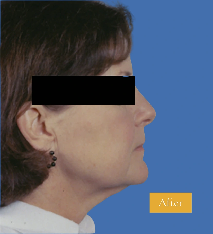 Rhinoplasty - Patient 3 (after)