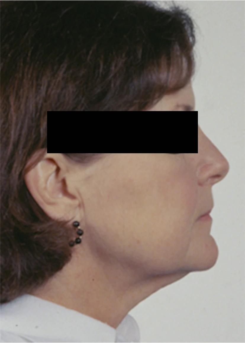 Rhinoplasty - Patient 3 (after)