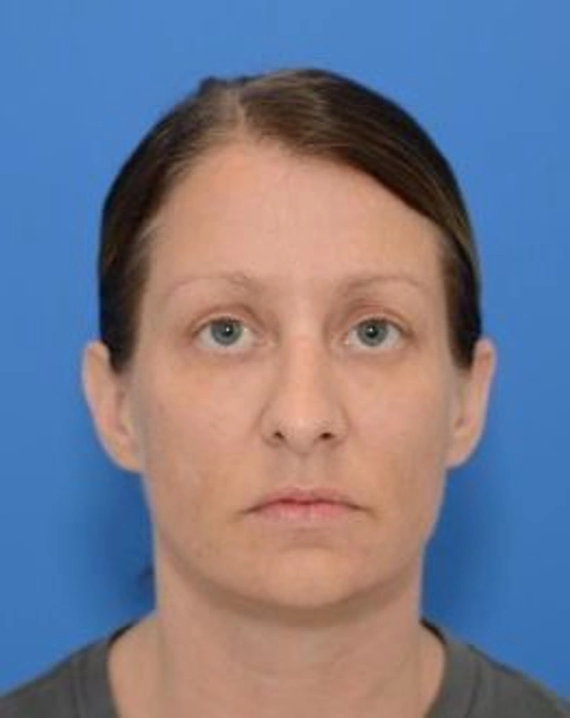 Upper Eyelid Surgery - Patient 4 (front view before)