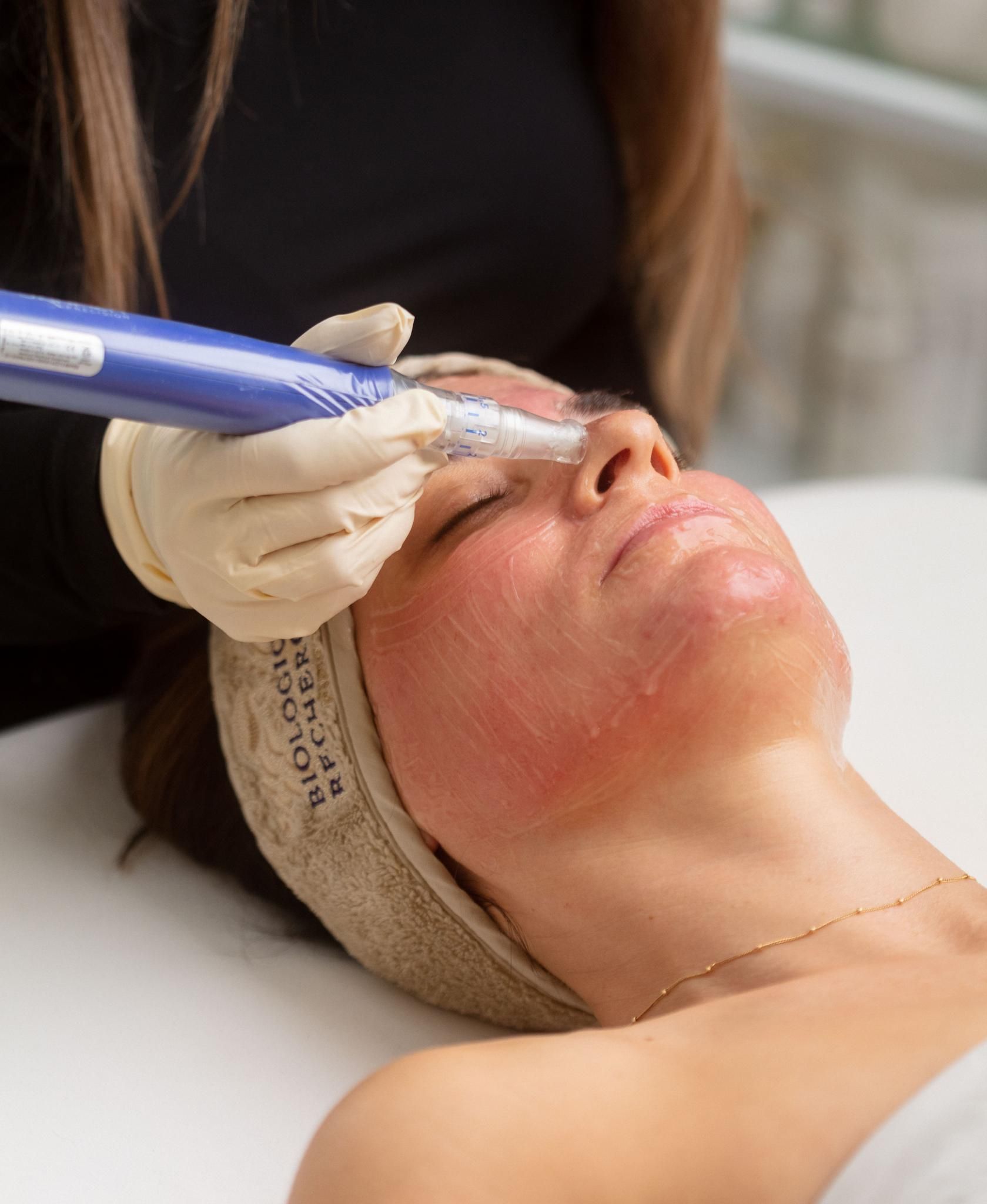 Blog How Combat Acne Scarring Microneedling Img1