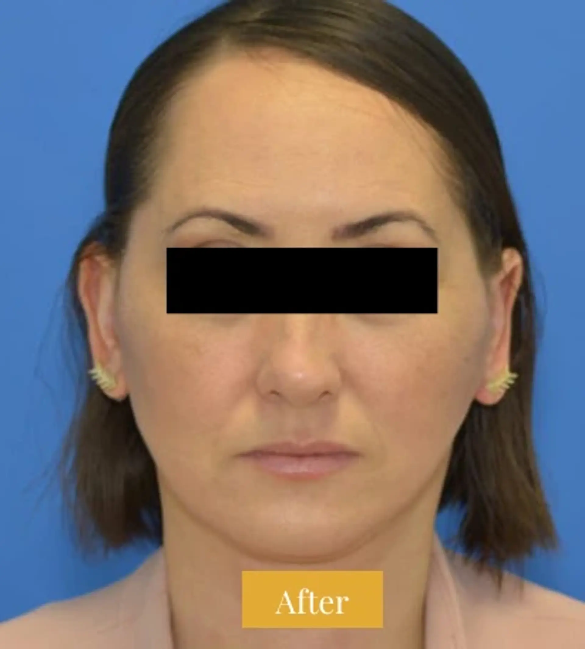 After Mini Facelift before and after