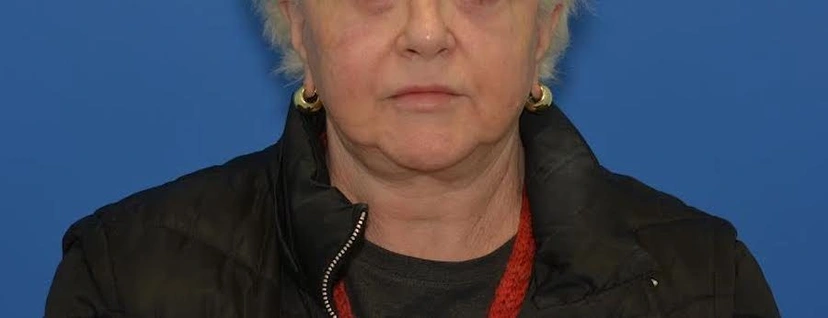 Morpheus8 RF Microneedling - Patient 5 (before)