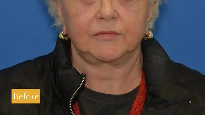 Morpheus8 RF Microneedling - Patient 5 (before)