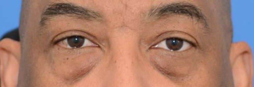 Lower Eyelid Surgery - Patient 1 (front view before)