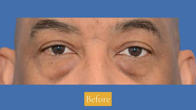 Lower Eyelid Surgery - Patient 1 (front view before)
