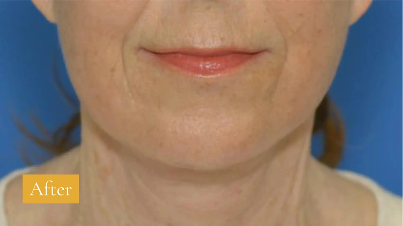 Facelift - Patient 1 (front view after)