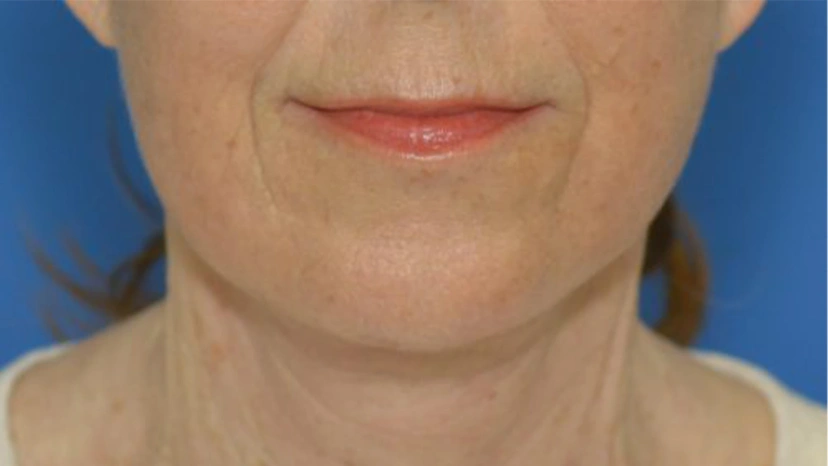 Facelift - Patient 1 (front view after)