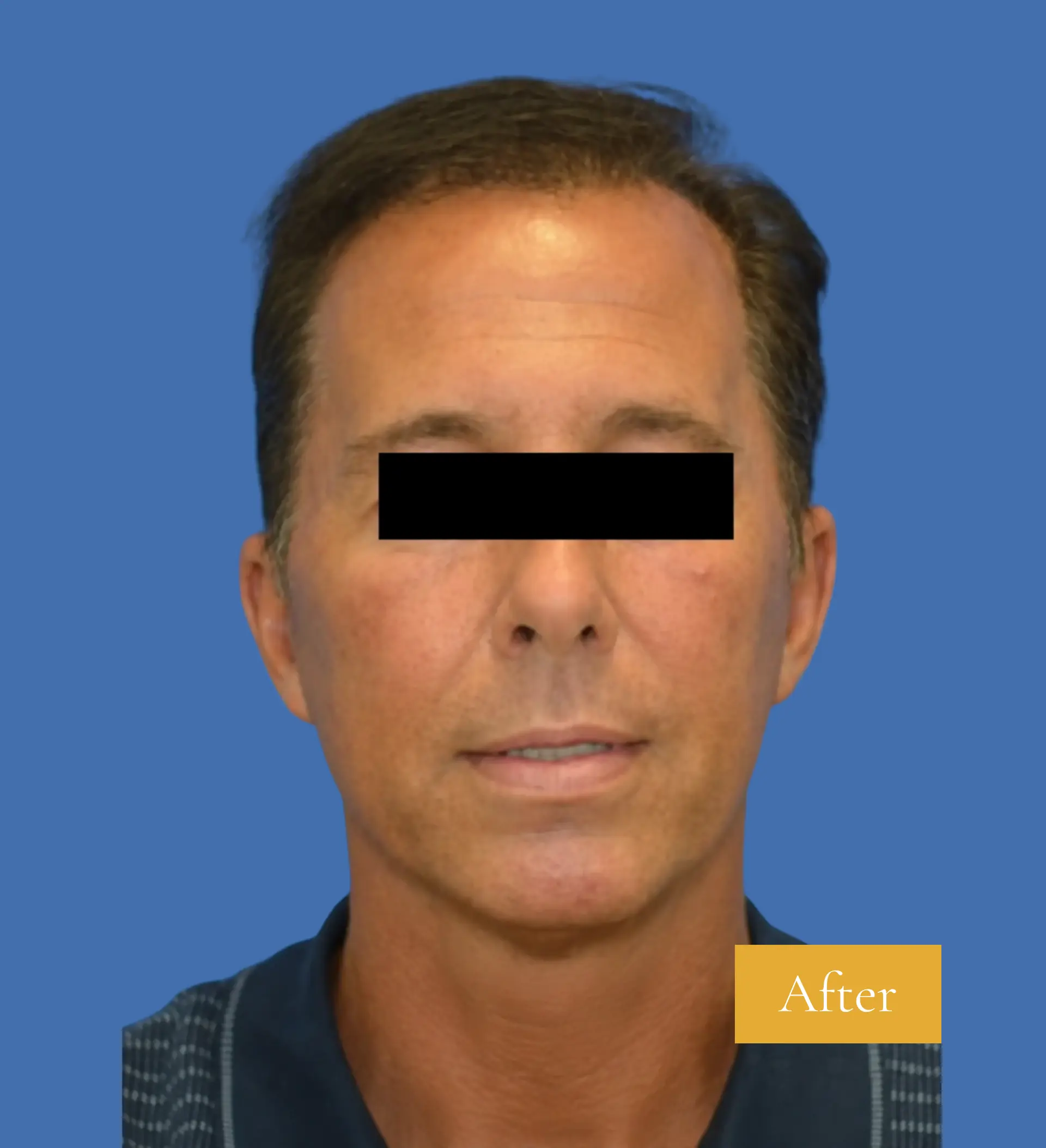 After Mini Facelift before and after