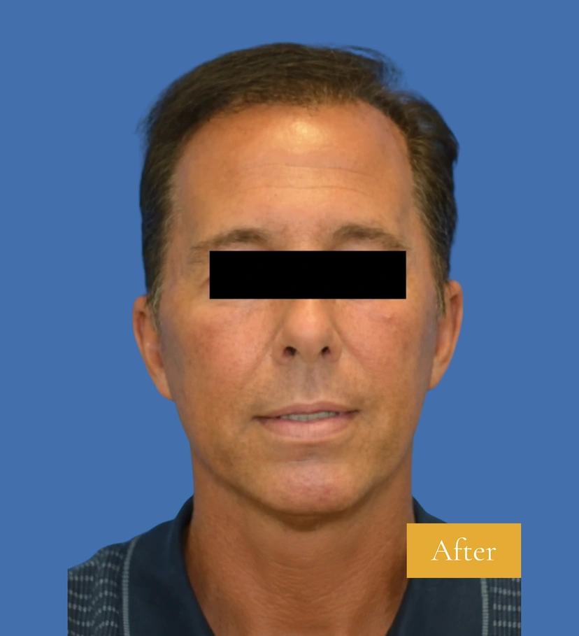 Mini Facelift/Short Scar - Patient 6 (after)