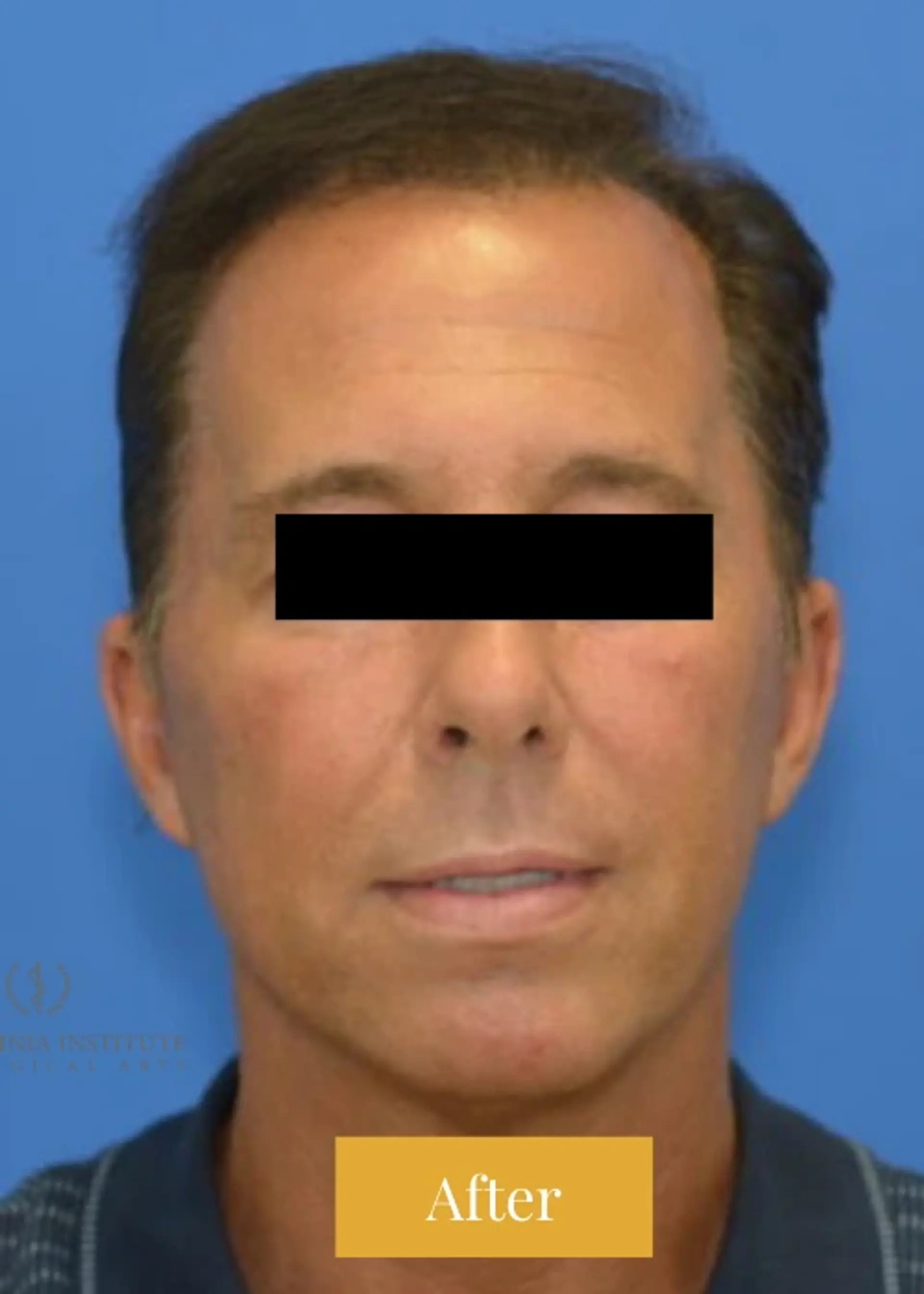 Before Facelift before and after