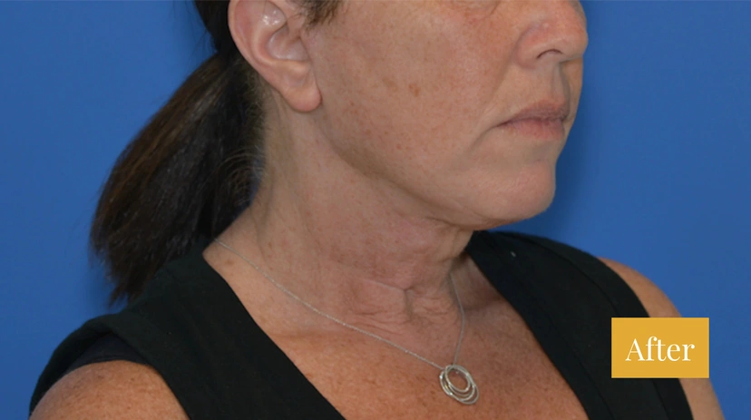 Facelift - Patient 10 - Set 1 - After