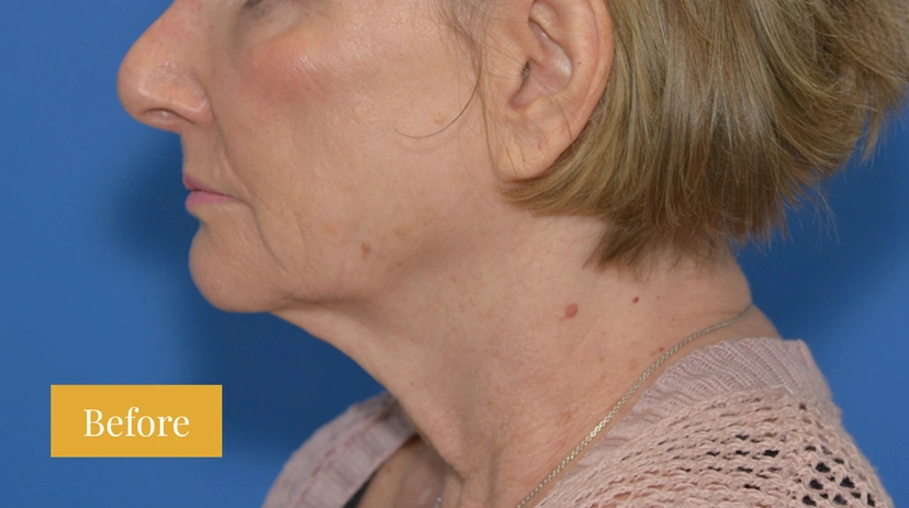 Facelift - Patient 9 - Set 1 - Before