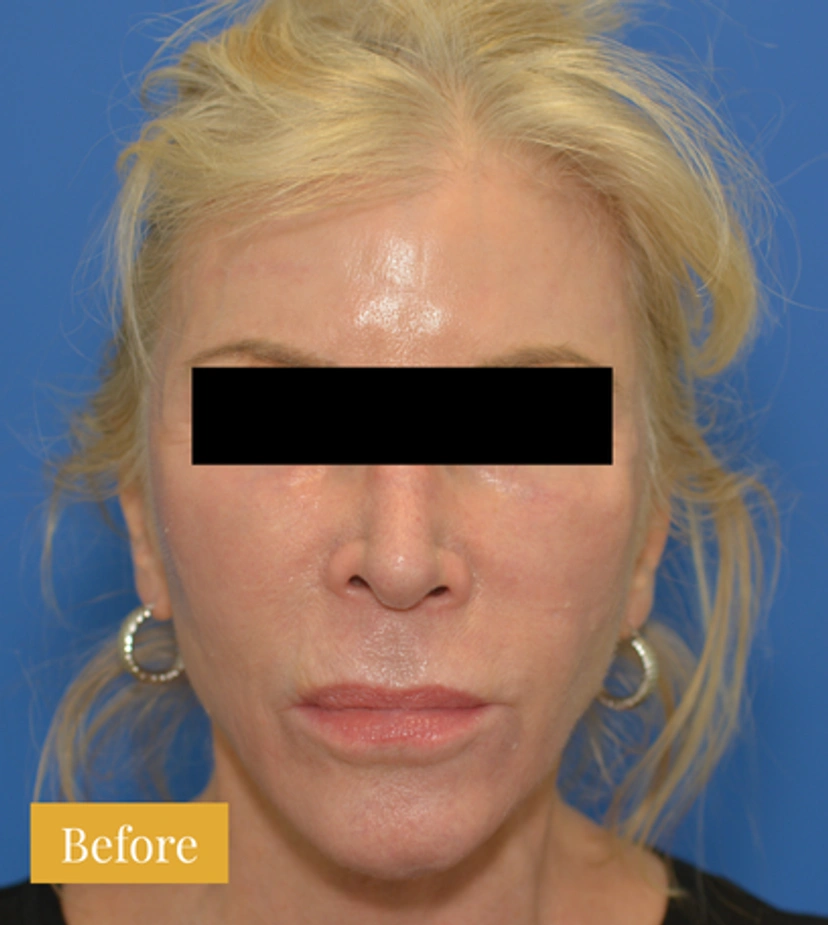 Eyebrow Lift - Patient 2 - Set 1 - Before