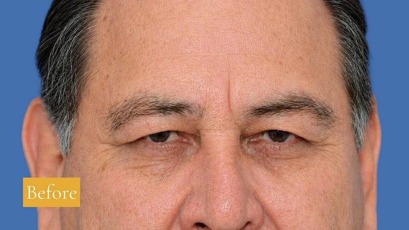 Eyebrow Lift - Patient 1 (before)