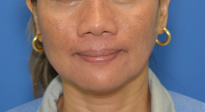 Microneedling - Patient 4 (after)