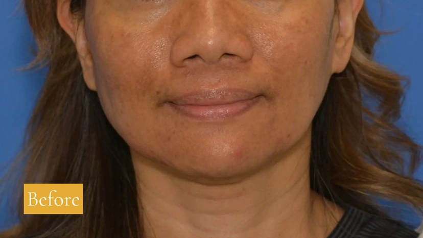 Microneedling - Patient 4 (after)