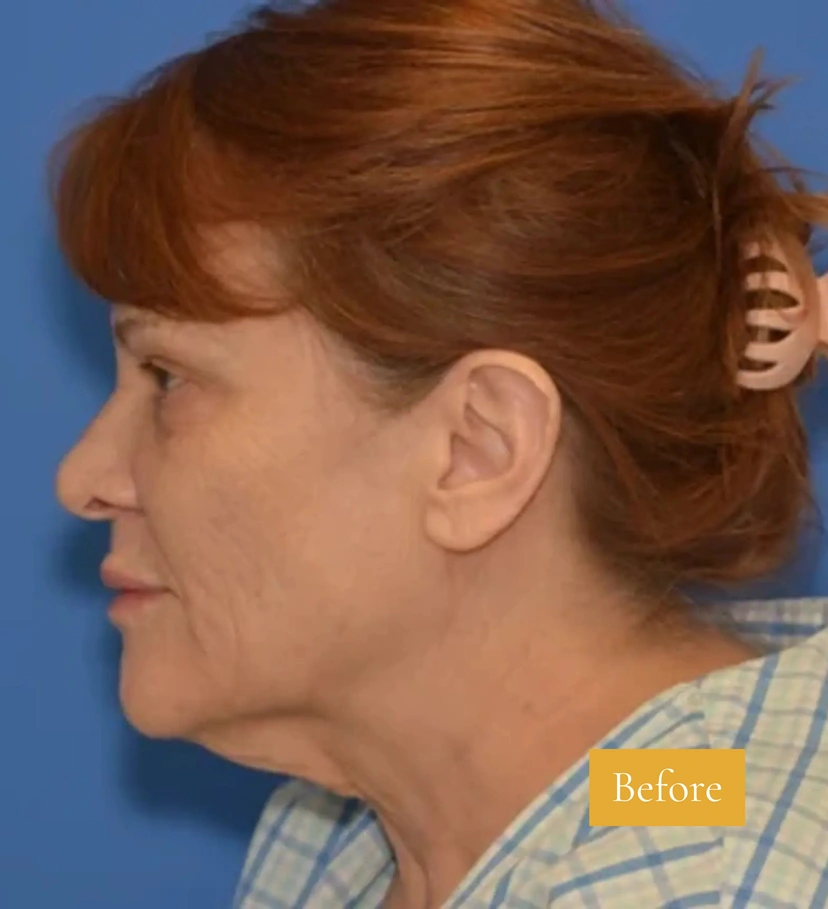 Facelift - Patient 14 - Set 1 - Before