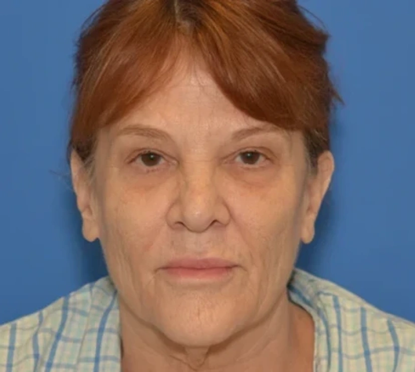 Facelift - Patient 14 - Set 1 - Before