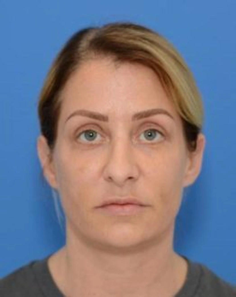 Lower Eyelid Surgery - Patient 2 (front view after)