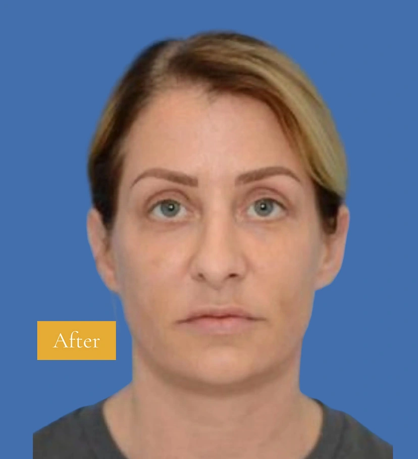 Lower Eyelid Surgery - Patient 2 (front view after)