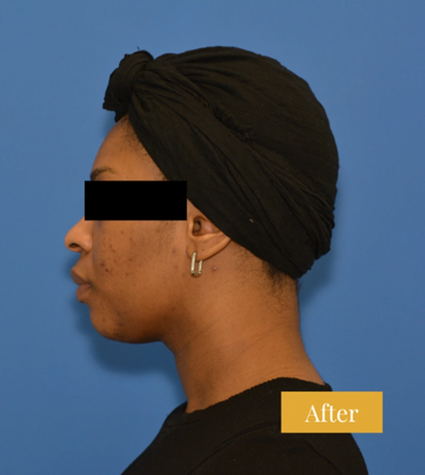 Chin Liposuction - Patient 2 - Set 1 - After