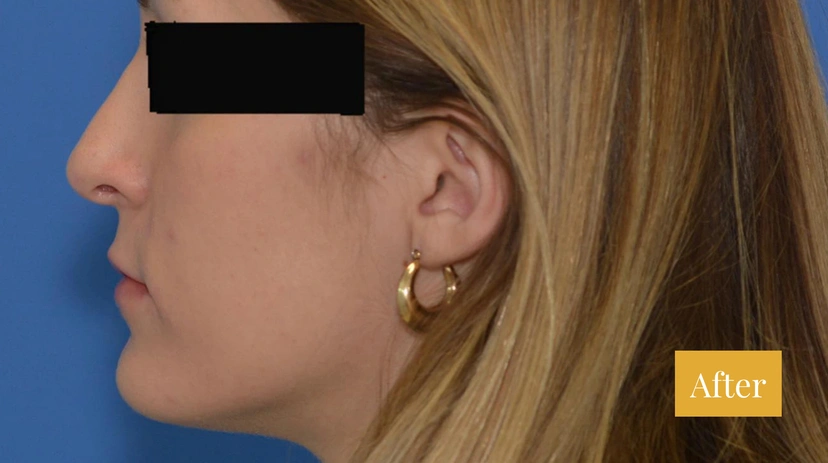 Rhinoplasty - Patient 11 - Set 1 - After