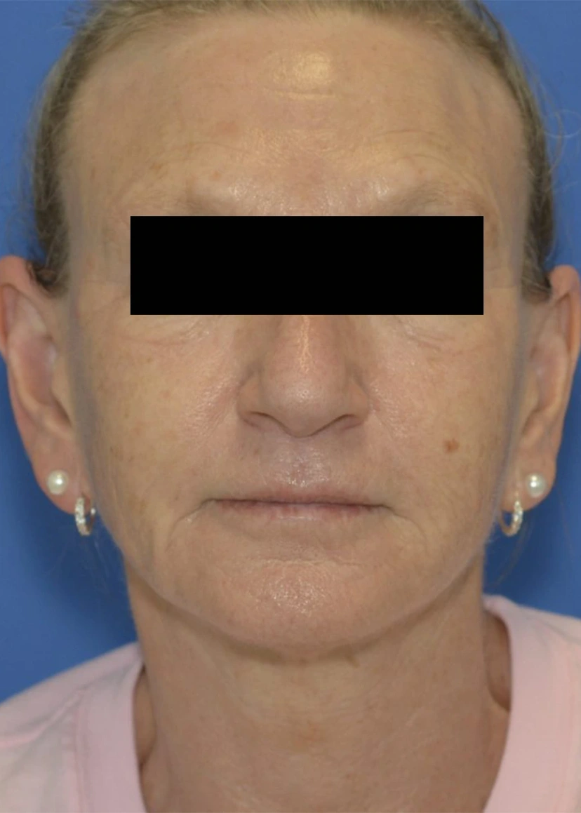 Botox - Patient 5 (front view after)