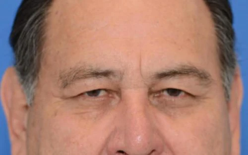 Before Blepharoplasty before and after
