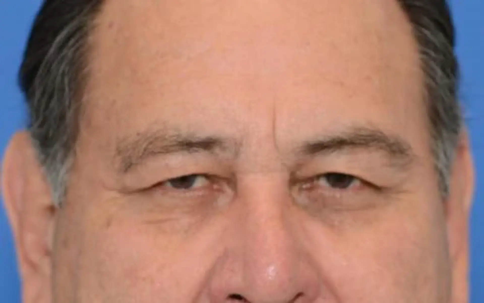 Before Blepharoplasty before and after