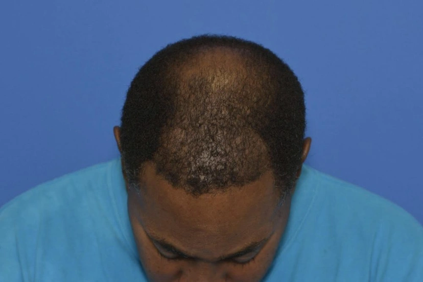 Hair Restoration - Patient 2 (after)