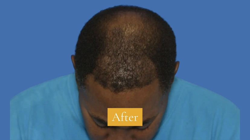 Hair Restoration - Patient 2 (after)