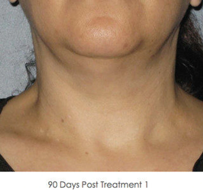 Ultherapy patient 6 result photo