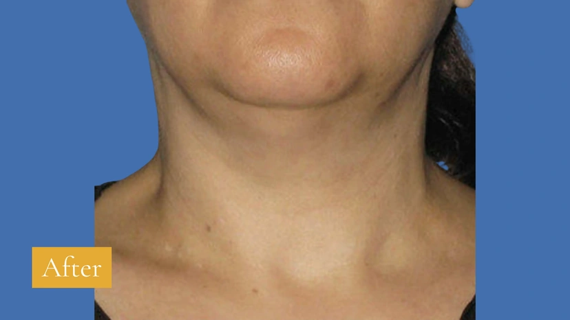 Ultherapy patient 6 result photo