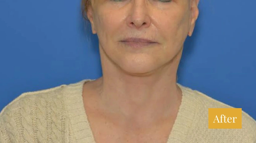 Facelift - Patient 3 (front view after)