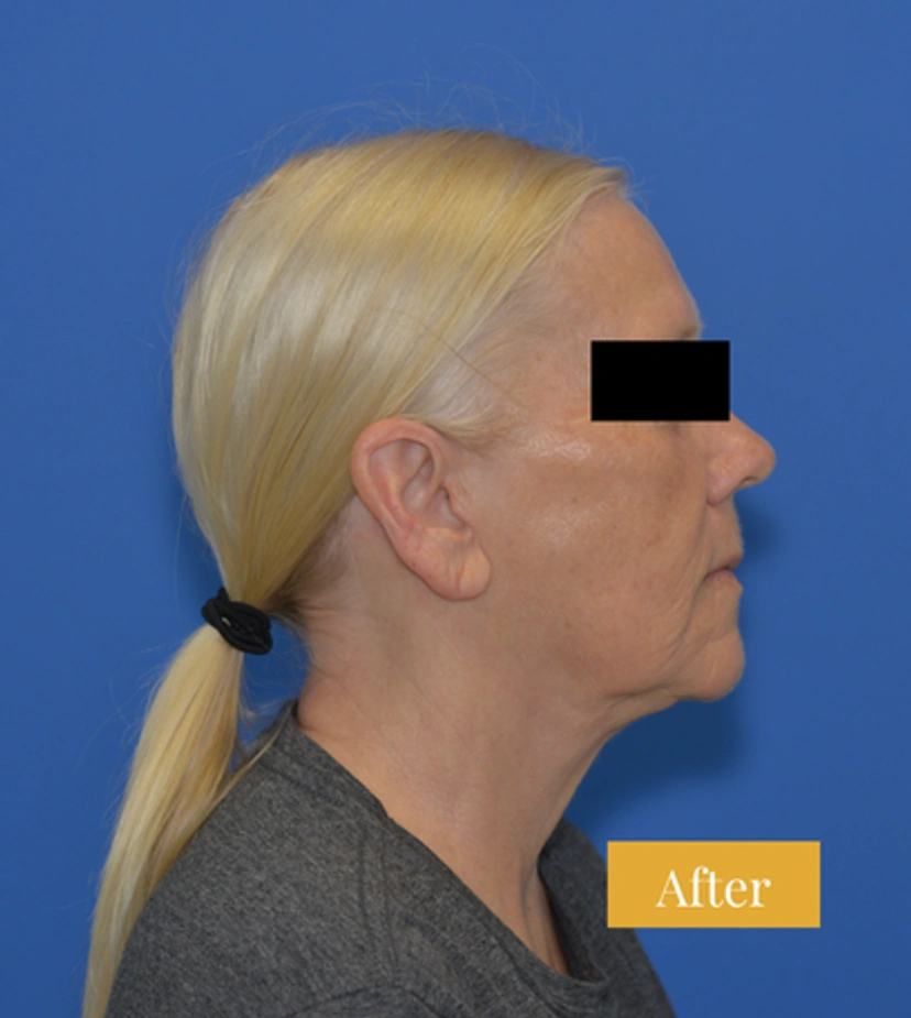 Neck Lift - Patient 2 - Set 1 - After