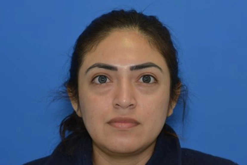 Dermal Fillers - Patient 1 (before)