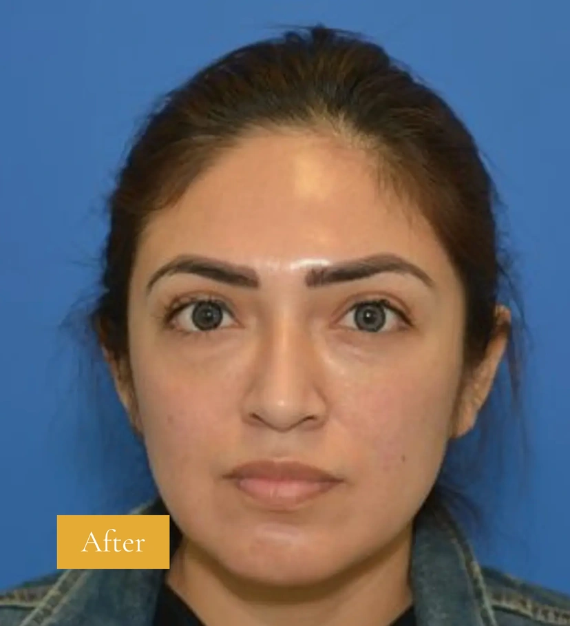 Dermal Fillers - Patient 1 (before)