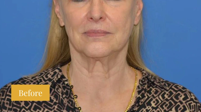 Facelift - Patient 3 (front view before)