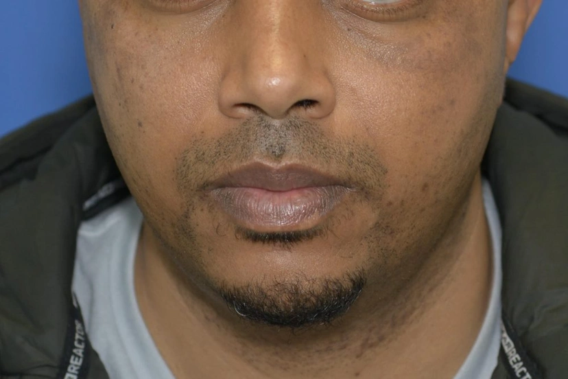 Microneedling - Patient 2 (before)