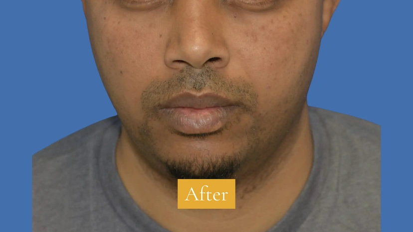 Microneedling - Patient 2 (before)