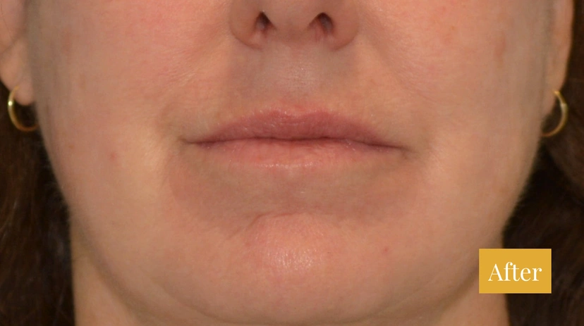 Fraxel - Patient 3 - Set 1 - After